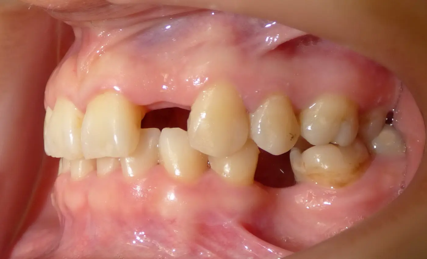 Caso de implante, lado izquierdo, antes del tratamiento