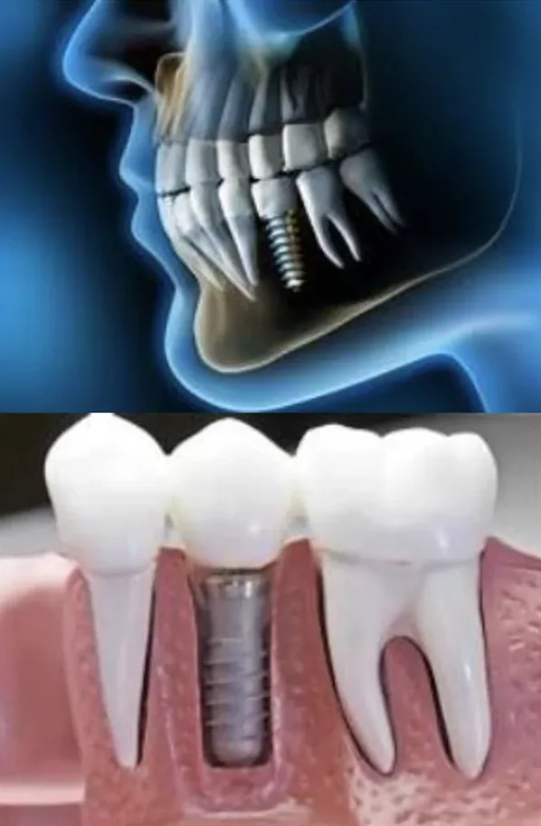 Diagrama de un implante dental integrado en el hueso mandibular